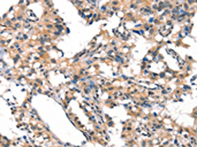 The image on the left is immunohistochemistry of paraffin-embedded Human thyroid cancer tissue using CYP2D6 Antibody(CYP2D6 Antibody) at dilution 1/30, on the right is treated with synthetic peptide. (Original magnification: ×200)Rabbit anti-Human CYP2D6 Polyclonal Antibody