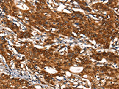 The image on the left is immunohistochemistry of paraffin-embedded Human gastic cancer tissue using the antibody Antibody) at dilution 1/30, on the right is treated with synthetic peptide. (Original magnification: ×200)Rabbit anti-Human CYP2D6 Polyclonal Antibody