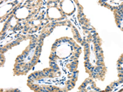 The image on the left is immunohistochemistry of paraffin-embedded Human thyroid cancer tissue using the antibody Antibody) at dilution 1/45, on the right is treated with synthetic peptide. (Original magnification: ×200)Rabbit anti-Human VGF Polyclonal Antibody