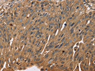The image on the left is immunohistochemistry of paraffin-embedded Human breast cancer tissue using SCGB2A1 Antibody(SCGB2A1 Antibody) at dilution 1/50, on the right is treated with fusion protein. (Original magnification: ×200)Rabbit anti-Human SCGB2A1 Polyclonal Antibody