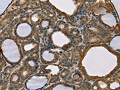 The image on the left is immunohistochemistry of paraffin-embedded Human thyroid cancer tissue using the antibody Antibody) at dilution 1/50, on the right is treated with fusion protein. (Original magnification: ×200)Rabbit anti-Human SCGB2A1 Polyclonal Antibody
