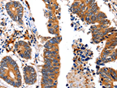 The image on the left is immunohistochemistry of paraffin-embedded Human colon cancer tissue using NCK1 Antibody(NCK1 Antibody) at dilution 1/30, on the right is treated with fusion protein. (Original magnification: ×200)Rabbit anti-Human NCK1 Polyclonal Antibody