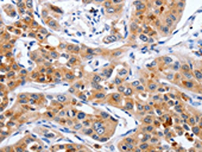 The image on the left is immunohistochemistry of paraffin-embedded Human lung cancer tissue using the antibody Antibody) at dilution 1/30, on the right is treated with fusion protein. (Original magnification: ×200)Rabbit anti-Human NCK1 Polyclonal Antibody