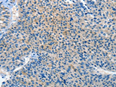 The image on the left is immunohistochemistry of paraffin-embedded Human liver cancer tissue using the antibody Antibody) at dilution 1/20, on the right is treated with synthetic peptide. (Original magnification: ×200)Rabbit anti-Human PRKX Polyclonal Antibody