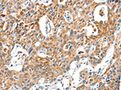 The image on the left is immunohistochemistry of paraffin-embedded Human lung cancer tissue using BAX Antibody(BAX Antibody) at dilution 1/30, on the right is treated with fusion protein. (Original magnification: ×200)
