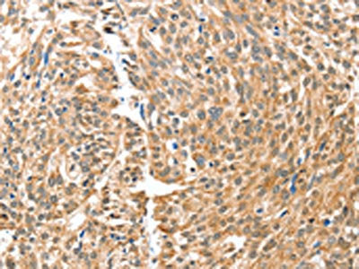 The image on the left is immunohistochemistry of paraffin-embedded Human esophagus cancer tissue using the antibody Antibody) at dilution 1/30, on the right is treated with fusion protein. (Original magnification: ×200)