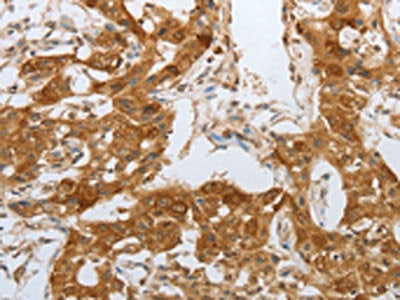 The image on the left is immunohistochemistry of paraffin-embedded Human lung cancer tissue using NPY1R Antibody(NPY1R Antibody) at dilution 1/25, on the right is treated with synthetic peptide. (Original magnification: ×200)Rabbit anti-Human NPY1R Polyclonal Antibody