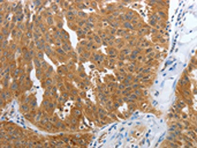 The image on the left is immunohistochemistry of paraffin-embedded Human ovarian cancer tissue using the antibody Antibody) at dilution 1/25, on the right is treated with synthetic peptide. (Original magnification: ×200)Rabbit anti-Human NPY1R Polyclonal Antibody