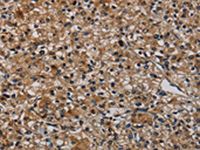 The image on the left is immunohistochemistry of paraffin-embedded Human prostate cancer tissue using TP53INP1 Antibody(TP53INP1 Antibody) at dilution 1/50, on the right is treated with synthetic peptide. (Original magnification: ×200)Rabbit anti-Human TP53INP1 Polyclonal Antibody