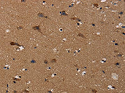 The image on the left is immunohistochemistry of paraffin-embedded Human brain tissue using the antibody Antibody) at dilution 1/50, on the right is treated with synthetic peptide. (Original magnification: ×200)Rabbit anti-Human TP53INP1 Polyclonal Antibody