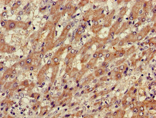 Immunohistochemistry of paraffin-embedded human liver cancer using the antibody at dilution of 1:100Rabbit anti-Human XBP1 Polyclonal Antibody