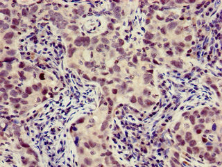Immunohistochemistry of paraffin-embedded human pancreatic cancer using XBP1 Antibody at dilution of 1:100Rabbit anti-Human XBP1 Polyclonal Antibody
