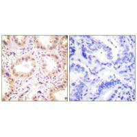 Immunohistochemistry analysis of paraffin-embedded human lung carcinoma tissue using NEDD8 antibody.Rabbit anti-Human NEDD8 Polyclonal Antibody