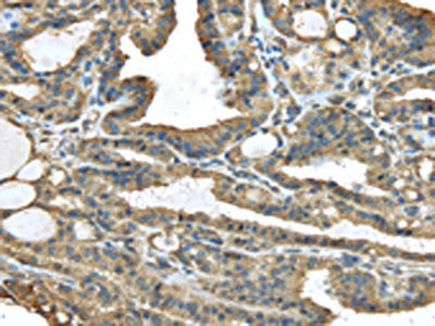 The image on the left is immunohistochemistry of paraffin-embedded Human thyroid cancer tissue using TMED1 Antibody(TMED1 Antibody) at dilution 1/35, on the right is treated with fusion protein. (Original magnification: ×200)Rabbit anti-Human TMED1 Polyclonal Antibody