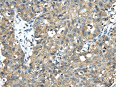 The image on the left is immunohistochemistry of paraffin-embedded Human breast cancer tissue using the antibody Antibody) at dilution 1/35, on the right is treated with fusion protein. (Original magnification: ×200)Rabbit anti-Human TMED1 Polyclonal Antibody