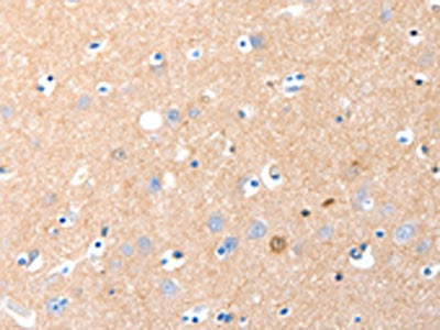 The image on the left is immunohistochemistry of paraffin-embedded Human brain tissue using GRM1 Antibody(GRM1 Antibody) at dilution 1/15, on the right is treated with synthetic peptide. (Original magnification: ×200)Rabbit anti-Human GRM1 Polyclonal Antibody