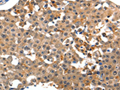 The image on the left is immunohistochemistry of paraffin-embedded Human breast cancer tissue using the antibody Antibody) at dilution 1/15, on the right is treated with synthetic peptide. (Original magnification: ×200)Rabbit anti-Human GRM1 Polyclonal Antibody