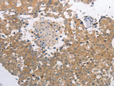The image on the left is immunohistochemistry of paraffin-embedded Human breast cancer tissue using the antibody Antibody) at dilution 1/40, on the right is treated with synthetic peptide. (Original magnification: ×200)Rabbit anti-Human PGA3/PGA4/PGA5 Polyclonal Antibody
