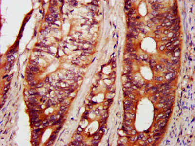IHC image of PAK4 Antibody diluted at 1:800 and staining in paraffin-embedded human colon cancer performed on a Leica BondTM system. After dewaxing and hydration, antigen retrieval was mediated by high pressure in a citrate buffer (pH 6.0). Section was blocked with 10% normal goat serum 30min at RT. Then primary antibody (1% BSA) was incubated at 4°C overnight. The primary is detected by a biotinylated secondary antibody and visualized using an HRP conjugated SP system.Rabbit anti-Human PAK4 Polyclonal Antibody