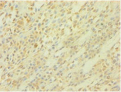Immunohistochemistry of paraffin-embedded human breast cancer using PICK1 Antibody at dilution of 1:100Rabbit anti-Human PICK1 Polyclonal Antibody
