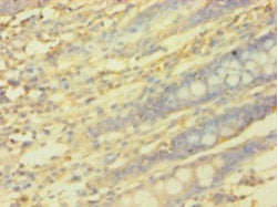 Immunohistochemistry of paraffin-embedded human colon tissue using PICK1 Antibody at dilution of 1:100Rabbit anti-Human PICK1 Polyclonal Antibody