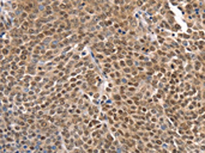 The image on the left is immunohistochemistry of paraffin-embedded Human ovarian cancer tissue using TAF15 Antibody(TAF15 Antibody) at dilution 1/20, on the right is treated with synthetic peptide. (Original magnification: ×200)Rabbit anti-Human TAF15 Polyclonal Antibody