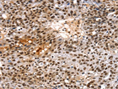 The image on the left is immunohistochemistry of paraffin-embedded Human breast cancer tissue using the antibody Antibody) at dilution 1/20, on the right is treated with synthetic peptide. (Original magnification: ×200)Rabbit anti-Human TAF15 Polyclonal Antibody