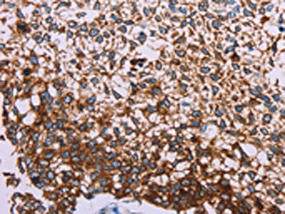 The image on the left is immunohistochemistry of paraffin-embedded Human cervical cancer tissue using KRT14 Antibody(KRT14 Antibody) at dilution 1/20, on the right is treated with synthetic peptide. (Original magnification: ×200)Rabbit anti-Human KRT14 Polyclonal Antibody