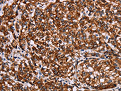The image on the left is immunohistochemistry of paraffin-embedded Human esophagus cancer tissue using the antibody Antibody) at dilution 1/20, on the right is treated with synthetic peptide. (Original magnification: ×200)