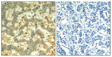 Immunohistochemical analysis of paraffin-embedded human breast carcinoma tissue using syk(Phospho-Tyr323) Antibody(left) or the same antibody preincubated with blocking peptide(right).Rabbit anti-Human SYK Polyclonal Antibody
