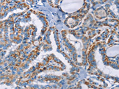 The image on the left is immunohistochemistry of paraffin-embedded Human thyroid cancer tissue using GPA33 Antibody(GPA33 Antibody) at dilution 1/30, on the right is treated with fusion protein. (Original magnification: ×200)Rabbit anti-Human GPA33 Polyclonal Antibody