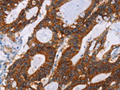 The image on the left is immunohistochemistry of paraffin-embedded Human colon cancer tissue using the antibody Antibody) at dilution 1/30, on the right is treated with fusion protein. (Original magnification: ×200)Rabbit anti-Human GPA33 Polyclonal Antibody