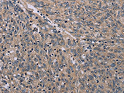 The image on the left is immunohistochemistry of paraffin-embedded Human ovarian cancer tissue using ACVR2A Antibody(ACVR2A Antibody) at dilution 1/20, on the right is treated with synthetic peptide. (Original magnification: ×200)Rabbit anti-Human ACVR2A Polyclonal Antibody