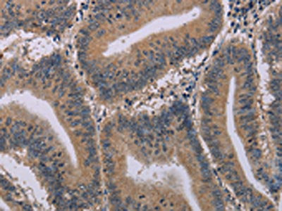 The image on the left is immunohistochemistry of paraffin-embedded Human colon cancer tissue using the antibody Antibody) at dilution 1/20, on the right is treated with synthetic peptide. (Original magnification: ×200)