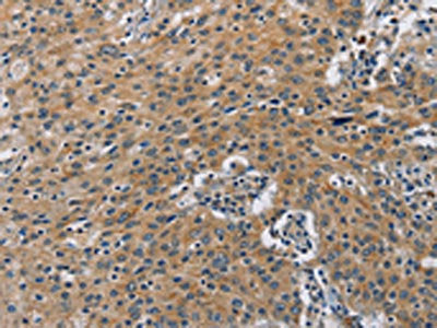 The image on the left is immunohistochemistry of paraffin-embedded Human gastric cancer tissue using BMP15 Antibody(BMP15 Antibody) at dilution 1/40, on the right is treated with fusion protein. (Original magnification: ×200)