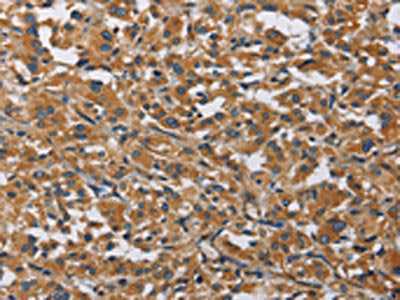 The image on the left is immunohistochemistry of paraffin-embedded Human thyroid cancer tissue using the antibody Antibody) at dilution 1/40, on the right is treated with fusion protein. (Original magnification: ×200)