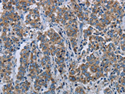 The image on the left is immunohistochemistry of paraffin-embedded Human liver cancer tissue using ELAVL3 Antibody(ELAVL3 Antibody) at dilution 1/20, on the right is treated with synthetic peptide. (Original magnification: ×200)Rabbit anti-Human ELAVL3 Polyclonal Antibody