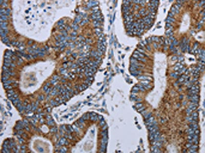 The image on the left is immunohistochemistry of paraffin-embedded Human colon cancer tissue using the antibody Antibody) at dilution 1/20, on the right is treated with synthetic peptide. (Original magnification: ×200)Rabbit anti-Human ELAVL3 Polyclonal Antibody