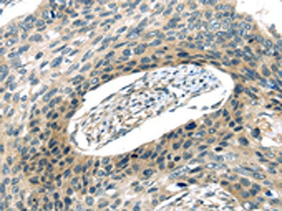 The image on the left is immunohistochemistry of paraffin-embedded Human esophagus cancer tissue using VAMP2 Antibody(VAMP2 Antibody) at dilution 1/20, on the right is treated with synthetic peptide. (Original magnification: ×200)Rabbit anti-Human VAMP2 Polyclonal Antibody