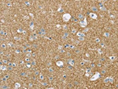 The image on the left is immunohistochemistry of paraffin-embedded Human brain tissue using the antibody Antibody) at dilution 1/20, on the right is treated with synthetic peptide. (Original magnification: ×200)Rabbit anti-Human VAMP2 Polyclonal Antibody