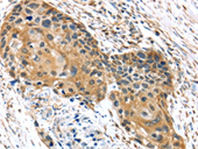 The image on the left is immunohistochemistry of paraffin-embedded Human esophagus cancer tissue using UBTD1 Antibody(UBTD1 Antibody) at dilution 1/30, on the right is treated with synthetic peptide. (Original magnification: ×200)Rabbit anti-Human UBTD1 Polyclonal Antibody