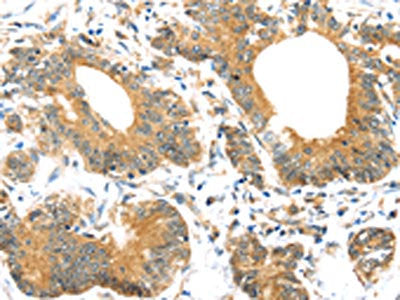 The image on the left is immunohistochemistry of paraffin-embedded Human colorectal cancer tissue using the antibody Antibody) at dilution 1/30, on the right is treated with synthetic peptide. (Original magnification: ×200)Rabbit anti-Human UBTD1 Polyclonal Antibody