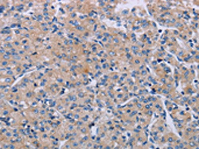 The image on the left is immunohistochemistry of paraffin-embedded Human prostate cancer tissue using P2RX3 Antibody(P2RX3 Antibody) at dilution 1/50, on the right is treated with synthetic peptide. (Original magnification: ×200)Rabbit anti-Human P2RX3 Polyclonal Antibody