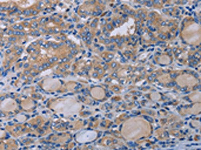The image on the left is immunohistochemistry of paraffin-embedded Human thyroid cancer tissue using the antibody Antibody) at dilution 1/50, on the right is treated with synthetic peptide. (Original magnification: ×200)Rabbit anti-Human P2RX3 Polyclonal Antibody