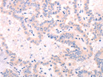 The image on the left is immunohistochemistry of paraffin-embedded Human thyroid cancer tissue using INA Antibody(INA Antibody) at dilution 1/25, on the right is treated with synthetic peptide. (Original magnification: ×200)Rabbit anti-Human INA Polyclonal Antibody