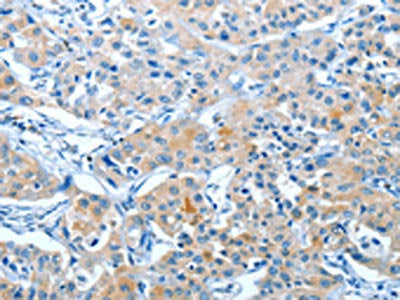 The image on the left is immunohistochemistry of paraffin-embedded Human lung cancer tissue using BAG3 Antibody(BAG3 Antibody) at dilution 1/20, on the right is treated with fusion protein. (Original magnification: ×200)