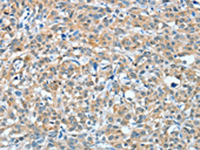 The image on the left is immunohistochemistry of paraffin-embedded Human esophagus cancer tissue using the antibody Antibody) at dilution 1/20, on the right is treated with fusion protein. (Original magnification: ×200)