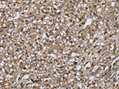 The image on the left is immunohistochemistry of paraffin-embedded Human prostate cancer tissue using FBP1 Antibody(FBP1 Antibody) at dilution 1/30, on the right is treated with fusion protein. (Original magnification: ×200)Rabbit anti-Human FBP1 Polyclonal Antibody