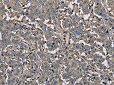 The image on the left is immunohistochemistry of paraffin-embedded Human liver cancer tissue using the antibody Antibody) at dilution 1/30, on the right is treated with fusion protein. (Original magnification: ×200)Rabbit anti-Human FBP1 Polyclonal Antibody