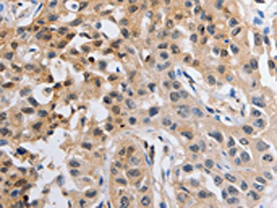 The image on the left is immunohistochemistry of paraffin-embedded Human lung cancer tissue using the antibody Antibody) at dilution 1/20, on the right is treated with fusion protein. (Original magnification: x200)Rabbit anti-Human NCK1 Polyclonal Antibody